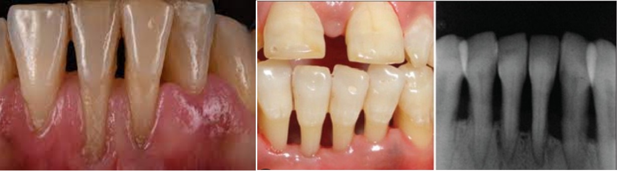 Protect Your Smile And Prevent Tooth Sensitivity With Our Expert Treatment For Gingival Recession